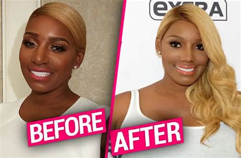 nene leaks before surgery|NeNe Leakes reveals she got a mini Brazilian butt lift